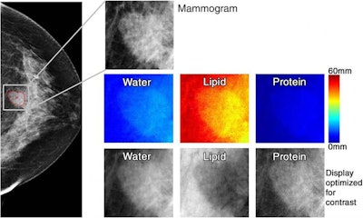71-year-old woman with 1.6-cm invasive ductal carcinoma (BI-RADS category 5, with category C breast density). Low-energy mammogram and corresponding regions of interest for mammogram (top) and breast tissue composition images (bottom two rows). Courtesy of RSNA.