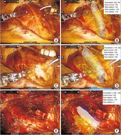 Clinicians can overlay 3D virtual models onto patient anatomy during thyroid surgery with augmented reality technology. Image courtesy of Lee et al. CC BY-NC 4.0.