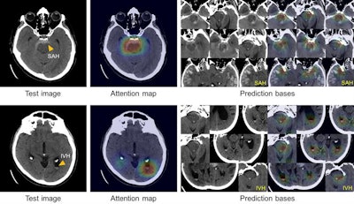 True-positive test CT images (first column) with subarachnoid hemorrhage (SAH) and intraventricular hemorrhage (IVH) along with the corresponding attention maps (second column) generated by the ICH detection deep-learning system. SAH and IVH example images determined by the model to be similar to the test images are retrieved from the atlas as the prediction basis (third and fourth columns). Images courtesy of Hyunkwang Lee and Dr. Sehyo Yune.