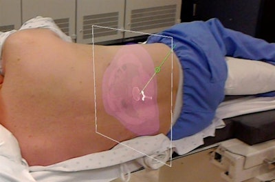 Augmented reality allows clinicians to view MRI and CT scans of the spine, labeled with planned trajectories for needle insertion, directly on a patient. Image courtesy of Jacob Gibby.