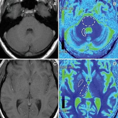 MR images of a 40-year-old woman with osteosarcoma who received 20 single doses of gadobutrol between 2007 and 2017. Transverse native T1-weighted spin-echo MR images (A, C) and corresponding transverse color-coded multiplanar reconstructions (B, D) of T1 maps. Images courtesy of Radiology.