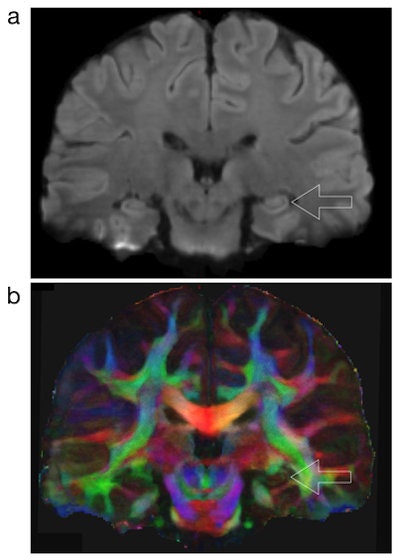 High-resolution DWI-MRI shows the structural connection to the hippocampus, which is associated with memory. The lower image (b) is color-coded, with red indicating left-right structural connectivity, green indicating anterior-posterior connectivity, and blue indicating superior-inferior connectivity. Images courtesy of Nan-kuei Chen, PhD.