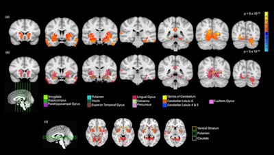 MRI shows brain regions with significantly greater gray-matter volume in 14-year-old subjects who reported one or two instances of cannabis use than in matched controls. Images courtesy of Orr et al and the Journal of Neuroscience.