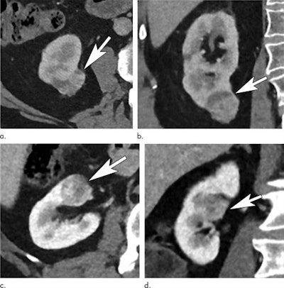 Renal tumors show low and high anatomic complexity. Contrast-enhanced (a) axial and (b) coronal abdominal CT images in a 70-year-old man diagnosed with a right renal tumor (arrows). Nephrometry score of 4 indicated noncomplex tumor anatomy. In the setting of mild (stage 2) chronic kidney disease, the ReAFFIRM model results would favor partial nephrectomy. Axial (c) and coronal (d) CT images in a 70-year-old man diagnosed with a centrally located renal neoplasm (arrows). The nephrometry score of 10 indicated high anatomic complexity because of interpolar location and contact with the collecting system and renal hilar vessels.