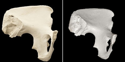 CT scan of a pelvic bone with cinematic rendering (left) and traditional volume rendering (right). Image courtesy of Dr. Nuttaya Pattamapaspong.
