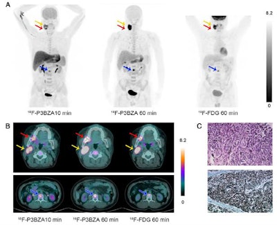 PET images from a melanoma patient. Maximum-intensity projection (A) at 10 and 60 minutes after F-18 P3BZA injection and at 60 minutes after F-18 FDG injection. Transverse images (B) of primary melanoma (red arrow), lymph node metastasis (yellow arrow), and bone metastasis (blue arrow). Hematoxylin and eosin (C, upper) and immunohistochemistry (C, lower) images of primary melanoma. Images courtesy of Ma et al and JNM.