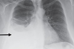 2019 01 18 23 37 9577 Chest Ai 400