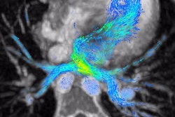 2019 01 22 21 49 7037 4 D Flow Mri 20190122213722