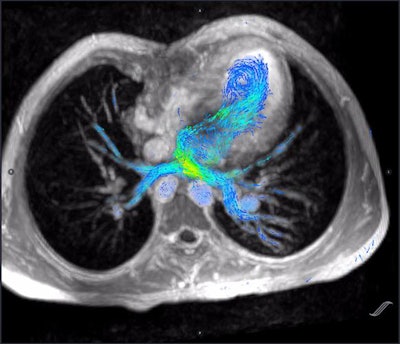Cardiac 4D flow MRI scan showing prepulmonary vein blood flow. Image courtesy of Dr. Albert Hsiao, PhD.