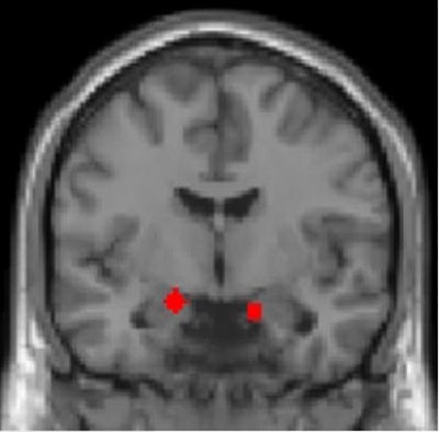 Functional MRI of combat veterans showed that the amygdala -- defined functionally in red -- is a particularly important area of the brain for predicting severity of PTSD symptoms. Image courtesy of Ilan Harpaz-Rotem, PhD; Daniela Schiller, PhD; and Nature Neuroscience.