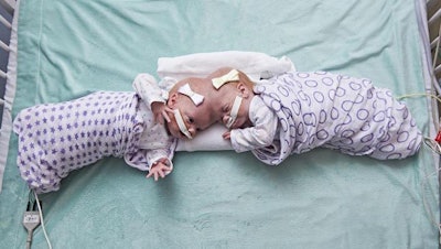 Craniopagus conjoined twins Erin and Abby Delaney. Image courtesy of the Children's Hospital of Philadelphia.