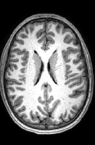MR image shows gray matter wrapping around the folds of the brain like a thin sheet. White matter, composing a large part of the image, connects brain cells and allows them to communicate. Image courtesy of CHLA.