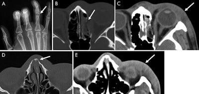 Images of a 21-year-old woman who presented initially with (A) oblique fracture of the right fourth proximal phalanx (arrow) on a frontal hand radiograph and (B) blowout fracture of the medial wall of the left orbit with (C) associated soft-tissue swelling on axial unenhanced CT images of the face. The same patient presented nine months later to a different hospital with (D) a chronic nasal bone fracture (not present on prior images) and (E) similar soft-tissue swelling of the left lateral face on axial unenhanced CT images of the face. Images courtesy of RSNA.