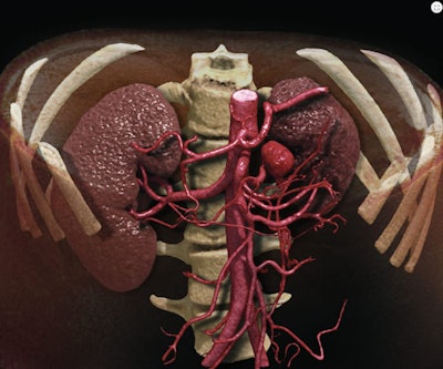 Global illumination allows for photorealistic rendering of an abdominal aneurysm. Image courtesy of Canon.
