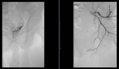 Angiogram of the left internal iliac artery showing the origin of the left prostatic artery and then very selective catheterization of the left prostatic artery by microcatheter.