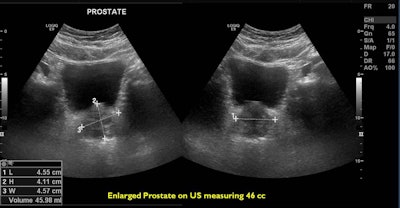 A 66-year-old patient with an International Prostate Symptom Score (IPSS) of 29 and prostate volume of 46 cc. All images courtesy of Dr. Jamal Al Deen Alkoteesh.