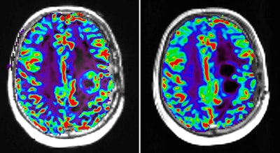 Perfusion MR image with dynamic susceptibility-weighted protocol shows activity of glioblastoma tumor before (left) and after (right) pharmaceutical therapy. Image courtesy of Image Analysis Group (IAG).