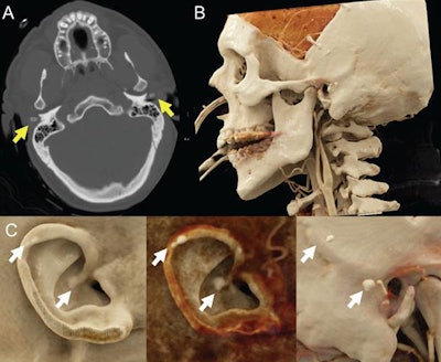 Head CT scan of a 47-year-old man with a history of traumatic brain injury (A). Auricular calcification is evident on the patient's cinematically rendered CT scans (B, C). Image courtesy of Dr. Michael Caton.