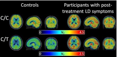 The radiotracer C-11 DPA-713 binds to a marker of inflammation. PET brain scans show elevated levels of the marker in participants with post-treatment Lyme disease syndrome. Image courtesy of Coughlin et al, Journal of Neuroinflammation.