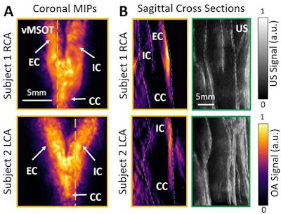 Images of the carotid artery bifurcation in two different patients using vMOT (A and B, orange boxes) and B-mode ultrasound (B, green boxes). Image courtesy of RSNA.
