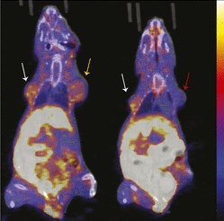 PET images show uptake of FFNP in tumor xenografts expressing PR-A or PR-B in mice. Representative coronal F-18 FFNP PET/CT images of MDA-MB-231 (red arrow), 231 PR-A (white arrows), and 231 PR-B (yellow arrow) tumor xenografts (19 days after implantation) from 12 mice imaged one hour after injection. Physiologic uptake from hepatobiliary clearance is also visualized. Images courtesy of Salem et al and JNM.