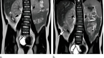 MR images from a 4-year-old girl with ruptured acute appendicitis. Coronal single-shot T2-weighted MR images (a, b) demonstrate a dilated fluid-filled appendix (arrow in a) and a contained rupture (arrow in b) with a small periappendiceal abscess formation. Images courtesy of Radiology.