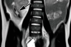 2019 02 15 23 27 9750 Mri Pediatric Appendix Mushtaq 20190215231244