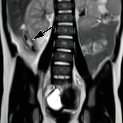 2019 02 15 23 27 9750 Mri Pediatric Appendix Mushtaq 20190215231244