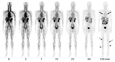Images are from a 55-year-old man with deep vein thrombosis and pulmonary embolism. Anterior maximum-intensity projections of F-18 GP1 PET/CT over 120 minutes show positive F-18 GP1 accumulation in pulmonary arteries (arrows) and in proximal (dotted arrows) and distal (arrowheads) veins of the leg, which are gradually distinct on late images as F-18 GP1 activity from other organs is excreted via urinary and hepatobiliary tracts. Images courtesy of Kim et al and JNM.