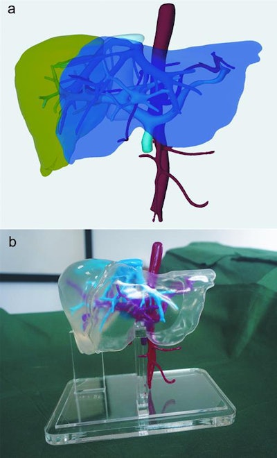 3D virtual liver model (a). 3D-printed liver model (b). Image courtesy of Dr. Zhong Lin.
