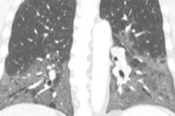 2019 02 27 17 01 2843 2019 02 27 Chest Ct Thumb