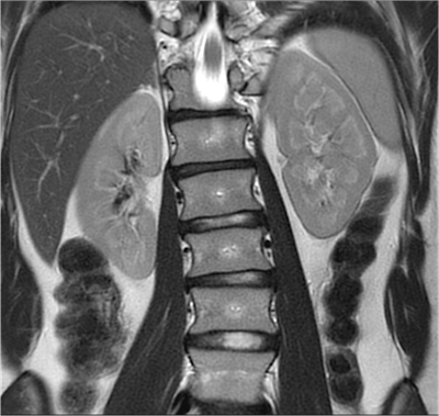 Coronal T2-weighted Propeller MR image