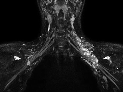 Ingenia Ambition MRI with 3D NerveView can help visualize the brachial and lumbar plexus with a high-resolution T2-weighted, turbo spin-echo acquisition with reduced remaining intralumen signal of the veins. Image courtesy of Philips Healthcare.