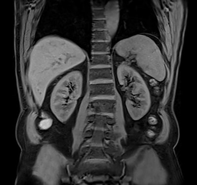 Abdominal MR scan taken on the 1.5-tesla Altea system using Caipirinha, a parallel imaging acquisition technique. Image courtesy of Siemens Healthineers.
