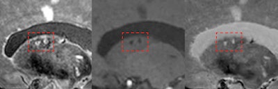 7-tesla MRI can detect the total burden of larger and smaller infarcts, including small microinfarcts in the deep gray matter (shown here inside red frames). Images are courtesy of Dr. Jeroen Hendrikse and originally appeared in ECR Today on 28 February 2019.