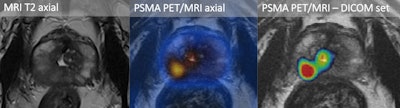 A 75-year-old with elevated PSA (5.2 ng/mL) and an unclear, not well-demarcated lesion on the right peripheral base of the prostate on multiparametric MRI. PSMA PET/MRI showed increased activity in the suspicious lesion. The fused PSMA PET/MRI DICOM dataset was imported to MedCom's BiopSee system, and targeted biopsy was performed. Histopathology confirmed aggressive prostate cancer (Gleason score 4+4). Images courtesy of Dr. Irene Burger.