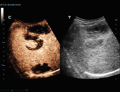 Contrast-enhanced ultrasound scan of liver lymphoma, using Ultra-Wideband Non-Linear (UWN+) technology. Image courtesy of Mindray.
