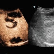 2019 03 02 21 30 9968 Mindray Ceus Of Liver Lymphoma V3 20190302212003