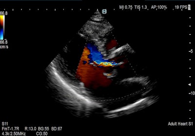 Color flow cardiac image acquired on Arietta 65 system. Image courtesy of Hitachi.