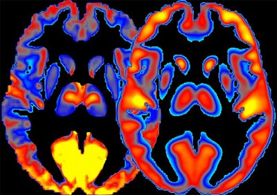 New imaging technique combines measures of brain activity (left) with glucose absorption (right). Image courtesy of Dr. Ehsan Shokri-Kojori.