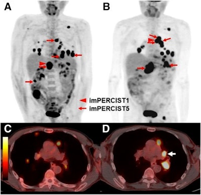 Images are from a 66-year-old man with progressive disease by PERCIST5 and PERCIST1 (due to the appearance of a new lesion), but stable metabolic disease by imPERCIST5. Maximum intensity projection (MIP) images were acquired at baseline (A) and follow-up (B). Target lesions for PERCIST5 and imPERCIST5 are indicated by red arrows (sum of SULpeak 47.61 at baseline). The target lesion for PERCIST1 at baseline is an abdominal lymph node (SULpeak, 15.07, red arrowhead). The follow-up scan (B) shows that the target lesion for PERCIST1 is a thoracic lymph node (SULpeak, 10.05), since SULpeak of the abdominal lymph node decreased to 8.86. Comparison of axial images of the chest at baseline (C) and follow-up (D) show the development of a new hypermetabolic left hilar lymph node (white arrow). This lesion (SULpeak, 9.29) was included in the target lesions for imPERCIST5. Images courtesy of JNM.