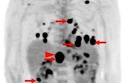 2019 03 06 23 11 3965 Pet Ct Weber Jnm 20190312181014