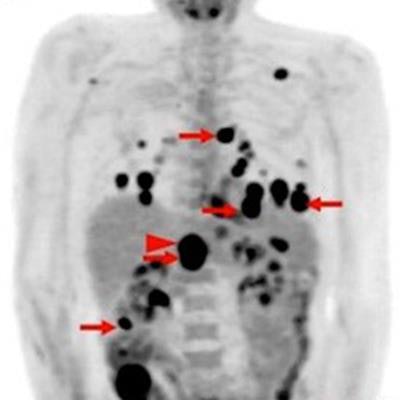 2019 03 06 23 11 3965 Pet Ct Weber Jnm 20190312181014