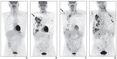 One PET/CT (A) was acquired five months after therapy and shows no signs of recurrence. The second scan (B) was performed 18 months after therapy and shows metastatic disease in the right hemithorax (black arrow) and right posterolateral pelvis (white arrow). The third scan (C) was conducted two months after the second PET/CT and shows a partial response of previous lesions to treatment and new bone (black arrow) and lung (white arrow) metastases. A fourth and final PET/CT (D) was obtained three months after the third scan and shows the disease progressing with new metastases in ribs (black arrows) and sacroiliac joint (white arrow). Images courtesy of AJR.