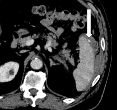 Figures 1A and 1B: Axial and frontal views of CT of the abdomen with IV contrast show a focus of active extravasation within the spleen (above) associated with a large subcapsular hematoma (below). All images courtesy of Dr. Shruthi Suresh et al.