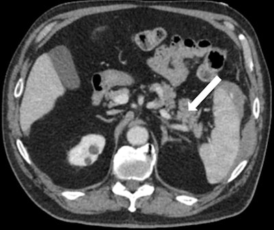 Figure 2: Axial view of CT of the abdomen demonstrates unremarkable appearance of the pancreas on arrival (white arrow).