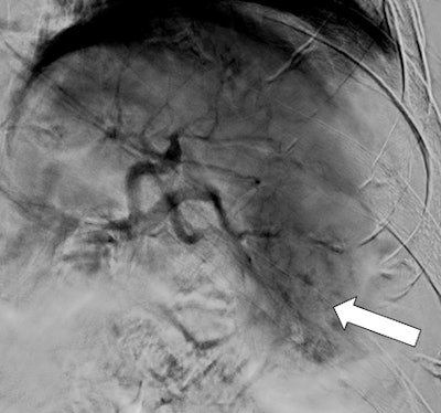 Figures 3A and 3B: Splenic arteriogram demonstrates diffuse injury at the inferior pole of the spleen (above with extravasation). Coils were deployed distally to the dorsal pancreatic artery (black arrow). Postembolization arteriogram shows stasis of blood flow in the mid and distal splenic artery (below).