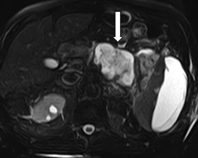 Figure 4: MRCP confirms an acute necrotic collection. T2-weighted sequence of an abdominal MRI demonstrates involvement of the pancreatic body and tail. The pancreatic duct is obliterated by the collection and cannot be appreciated.