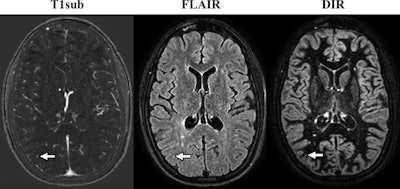 Axial MR images come from a 32-year-old woman with relapsing-remitting multiple sclerosis. Images were obtained with the subtraction of an unenhanced T1-weighted MR image from contrast-enhanced MR image (T1sub), FLAIR, and DIR. A new small subcortical lesion (arrow) in the right parietal lobe is seen only on the contrast-enhanced image but is overlooked on DIR and FLAIR sequences. There are several other new or enlarged lesions that can be seen on nonenhanced images. Images courtesy of Radiology.