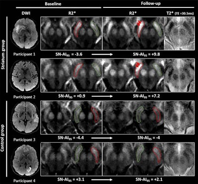 MR images show examples of visual R2* modifications within substantia nigra at baseline (24-72 hours after stroke) and at one-year follow-up in striatum (participants 1 and 2) and control groups (participants 3 and 4). Axial R2* maps are enlarged at mesencephalon level and one of the individual T2* echoes also is shown at follow-up. The substantia nigra is segmented in red ipsilateral to infarct and in green contralateral to infarct. Images without outlines are also shown. Brighter R2* spots are pointed with red arrows. Asymmetry index of 95th percentile of R2* within substantia nigra (SN-AI95) measured in these participants are indicated for reference. Participants 1 and 2 show marked asymmetry of R2* within ipsilateral substantia nigra at follow-up, compared with baseline after infarct involving entire striatum (participant 1) or limited to putamen (participant 2). Asymmetry also is visible on individual T2* echo at follow-up. Conversely, no asymmetry was observed in participants 3 and 4 sparing striatum. Images courtesy of Radiology.